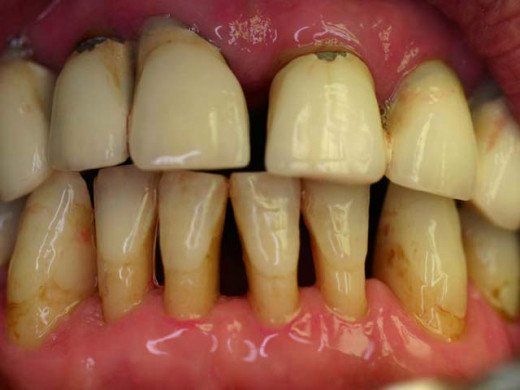How long can you keep your teeth with Periodontal Disease